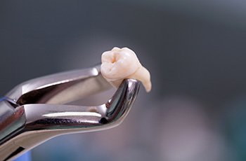 Dental forceps holding an extracted tooth