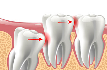 illustration of an impacted tooth